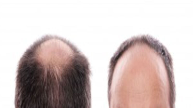 Value of Hair Transplant Procedure as Seen by Residents in Washington, DC