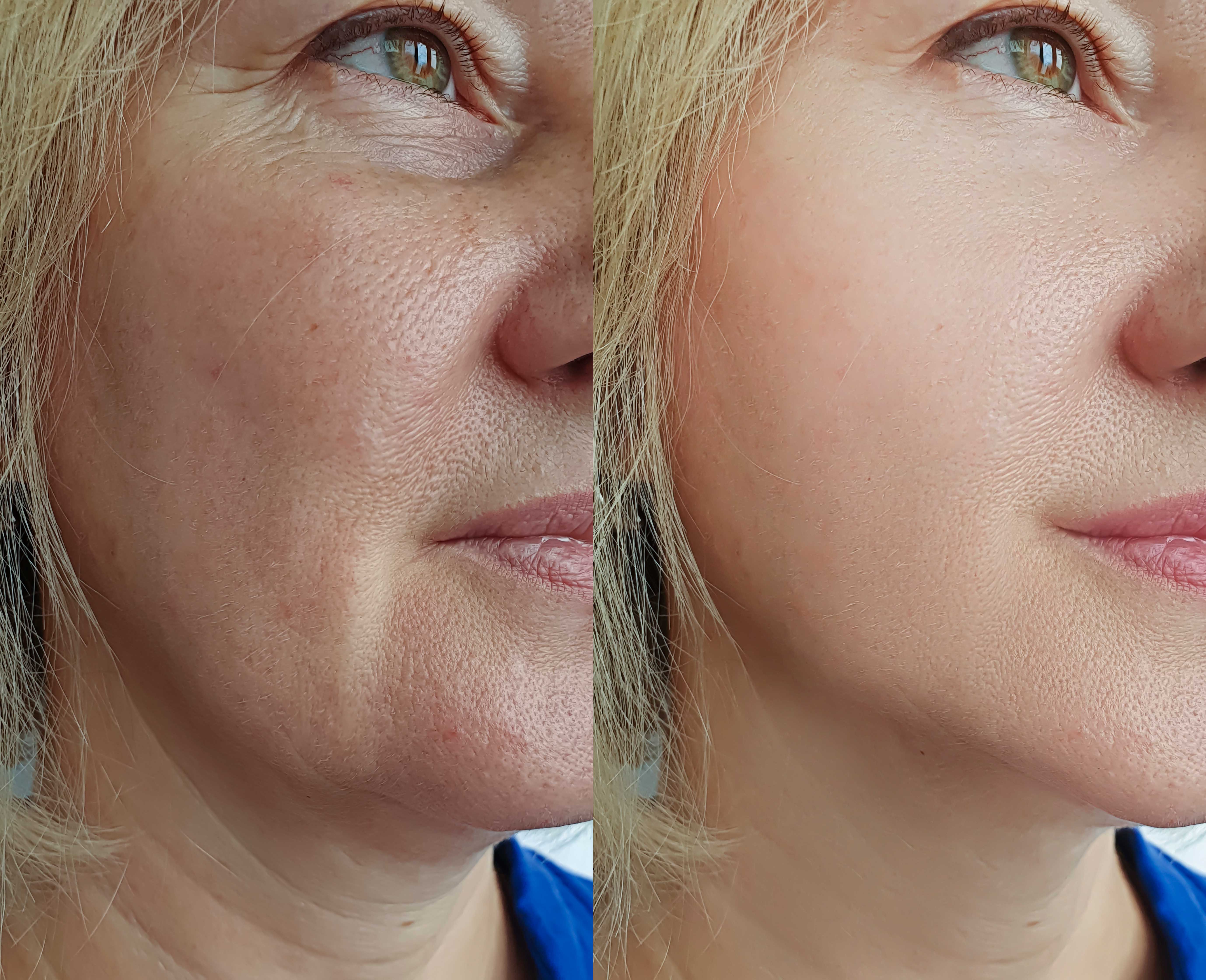 Helping You Look Younger With Minimally Invasive Lift Treatments