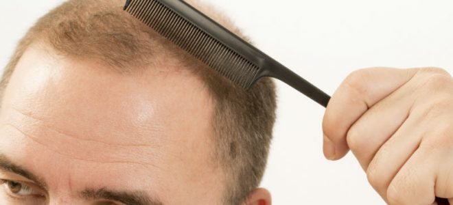 What Should Patients Understand About Getting Hair Restoration in CT