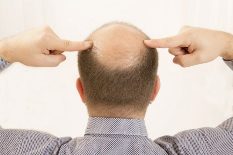 Why Should You Consider a Hair Restoration Treatment in Philadelphia, PA?