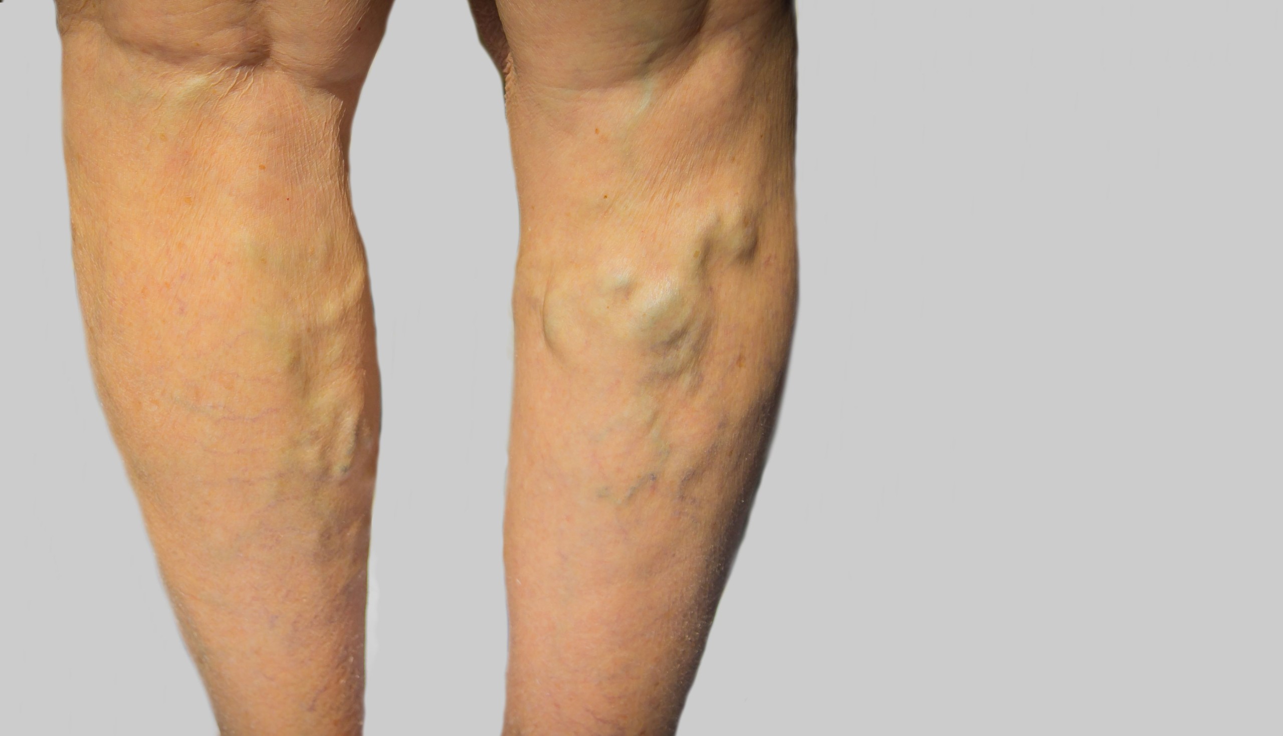 How Varicose Vein Treatment in Bucks County, PA, Can Transform Your Life