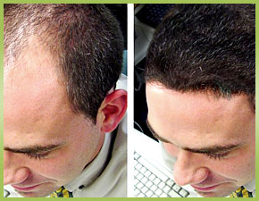 Restore A Younger Appearance At A Hair Transplant Clinic in Washington DC