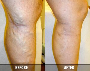 Easy Vein Treatment in the Schaumburg Area