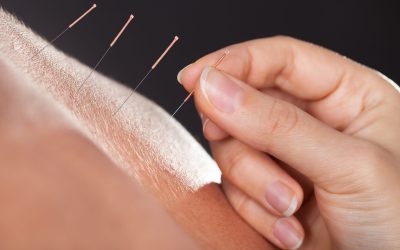 Find a Licensed Acupuncturist in Burbank CA, Your Path to Natural Healing