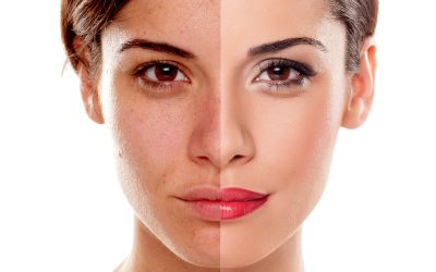 Rejuvenate Skin and Restore Youthful Radiance with a Vampire Facial in Jacksonville, FL